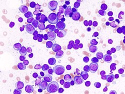 Illustration of the multiple 0myeloma