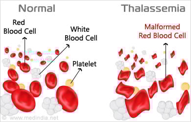 thalassemia